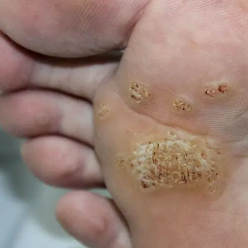 Verruga Plantar